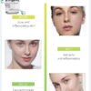 Luxury Derma Mesotheraphy-Acne Treatment